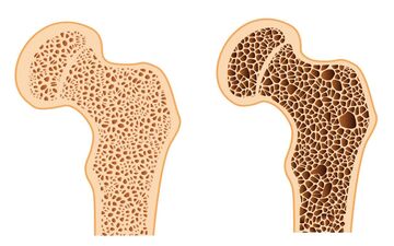 نقش الگوهای غذایی در پیشگیری و کنترل پوکی استخوان
