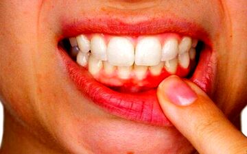 احتمال ابتلا به زوال عقل درصورت داشتن لثه‌های ناسالم 