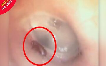 لحظه خارج کردن مورچه از گوش بیمار! +فیلم 