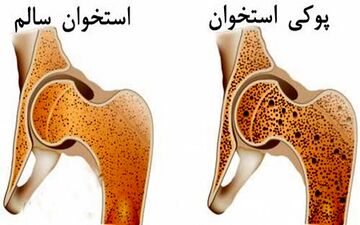 پوکی استخوان و آرتروز زانو؛ راهکارهای پیشگیری و درمان