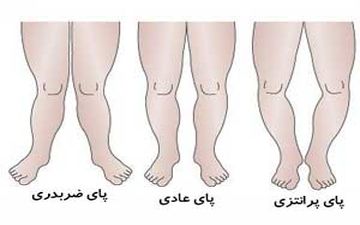  ایجاد پای پرانتزی و صافی کف پا در کودکان به چه علت است؟