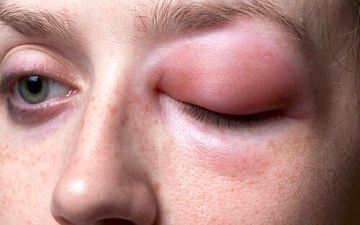 آنژیوادم کهیری ساده اما خطرناک!