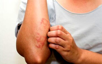 بیماری پسوریازیس (psoriasis) چیست؟