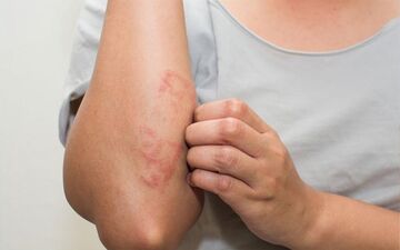 بیماری پسوریازیس (psoriasis) چیست؟