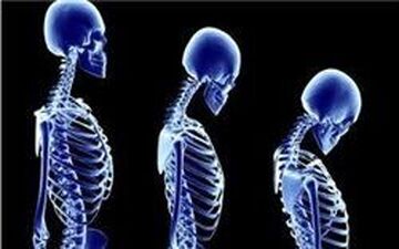 شانه‌های یخ زده |  بیماری شانه‌‌های یخ زده چیست و چه علائمی دارد؟