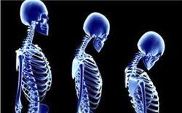شانه‌های یخ زده |  بیماری شانه‌‌های یخ زده چیست و چه علائمی دارد؟