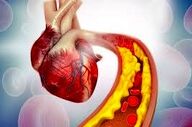 کلسترول بد را چه نوشیدنی هایی کاهش می دهد؟