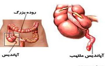 تاثیر آپاندیس بر دستگاه گوارش و سیستم ایمنی بدن 