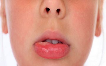 ورم بی دلیل لب ، علل و راههای درمان ورم لب 