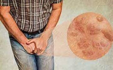 آشنایی با دو بیماری جنسی که در ایران شایع است
