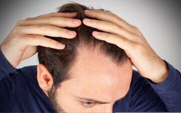  این غذاها را نخورید تا ریزش مو نگیرید

