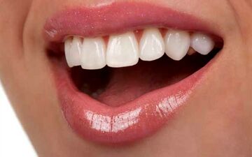 لبخندی درخشان و سفید با پیشگیری و راه های از بین بردن سیاهی دندان
