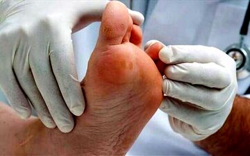 نکاتی طلایی برای پیشگیری از ابتلا به زخم پای دیابتی