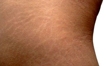 راه حلی برای رفع ترک های پوستی