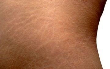 راه حلی برای رفع ترک های پوستی