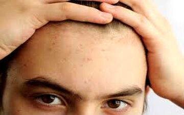  اگر پیشانی تان جوش میزند،راه حل آن اینجاست