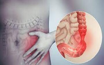 ارتباط بین روده و بیماری گلوکوم