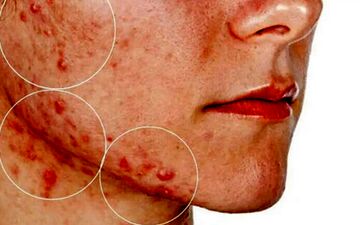 برای سلامت پوست چکار کنیم؟| لمس صورت باعث بروز و یا تشدید آکنه می شود؟