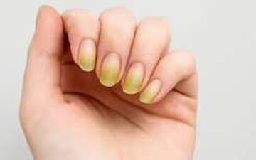چه زمانی زردی ناخن به بررسی پزشکی نیاز دارد؟
