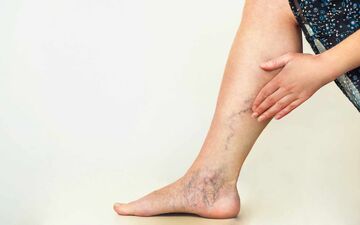 زنگ خطر برای مبتلایان به واریس: احتمال ابتلا به زوال عقل بالاتر از حد تصور