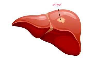 خطر سرطانی شدن کیست‌های کبدی چقدر است؟