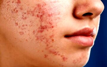اثرات رژیم غذایی بد روی پوست