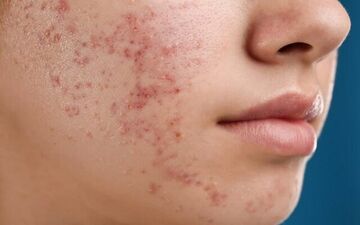 اثرات رژیم غذایی بد روی پوست