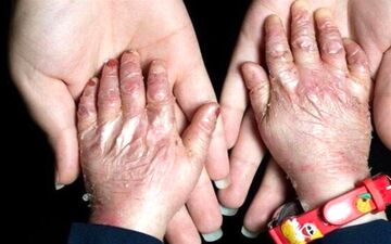 سهمیه تابستان پانسمان‌های تخصصی به خانه EB تحویل شد