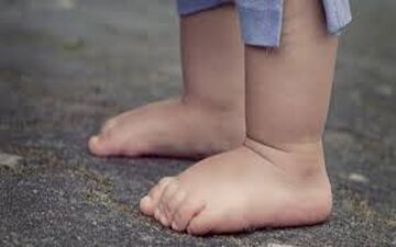 کف پای صاف در کودکان چه هنگام خطرناک است؟