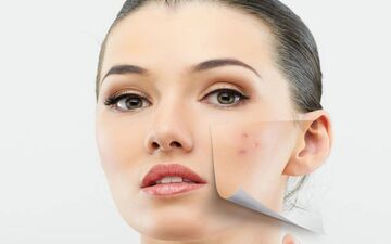 روش های خانگی برای از بین بردن لک صورت