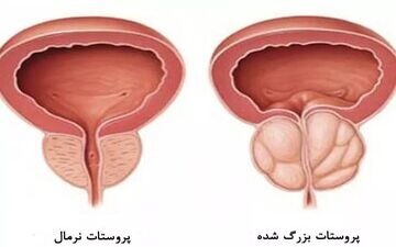 پیشگیری از بزرگی پروستات بدون دارو

