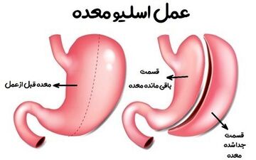 آنچه در مورد جراحی اسلیو معده باید بدانید