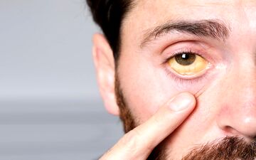 زردی بزرگسالان چیست؟ + راه درمان (علائم و علت زردی در بزرگسالان)