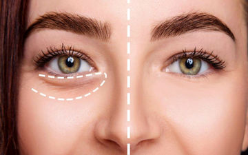 طبق دستورات طب سنتی چگونه پف زیر چشم را از بین ببریم؟