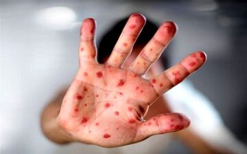 ابتلای ۴۲۲ نفر به سرخک در ۳ ماه اول سال/ شیوع بالاتر بیماری در ۲ استان