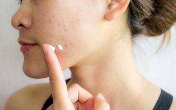 جوش‌های تابستانی: چرا ایجاد می‌شوند و چگونه آن‌ها را درمان کنیم؟
