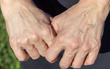 چه زمانی نمایان شدن رگ‌ها طبیعی است و چه زمانی نشانه بیماری؟