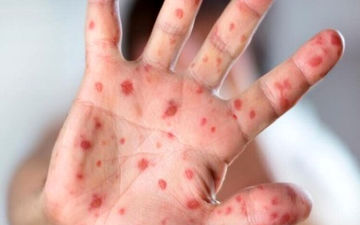 زنگ خطر شیوع سرخک به صدا در آمد

