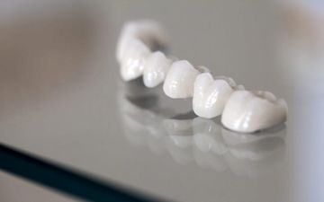 روکش دندان چیست و مراحل انجام آن چگونه است؟