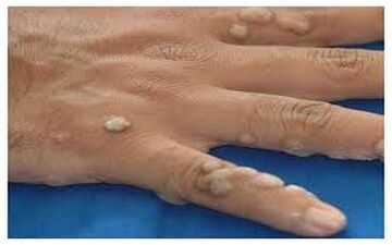 در مورد  ویروس HPV را حتما بشناسید چون احتمال ابتلا به آن بسیار بالاست!