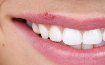 خانم‌های زیبا و حساس نگران تبخال زدن نباشید | این ویتامین‌ها را مصرف کن تا تبخال نزنی!
