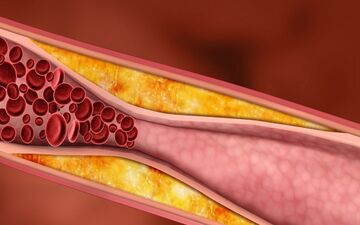 با کلسترول ناخوانده چه کنیم؟