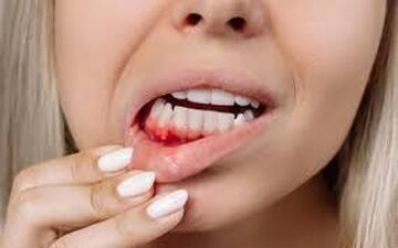 چرا لثه خونریزی میکند؟ 