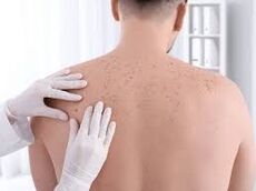 این لکه‌ها و خال‌ها را جدی بگیرید؛ زنگ خطر سرطان پوست