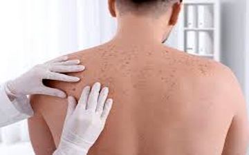  سرطان پوست؛ علل، پیشگیری و رژیم غذایی