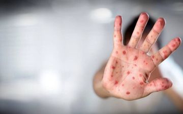 وزارت بهداشت تایید کرد؛ شناسایی ۹ مورد مشکوک به آبله میمونی در ایران/ منتظر نتیجه آزمایش هستیم