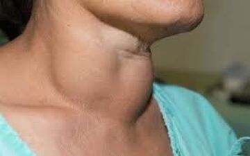 روش های تشخیص سرطان تیروئید