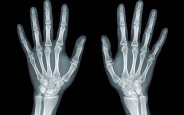 روشی جدید برای مقابله با متاستاز استخوانی