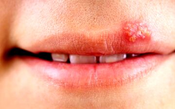 تبخال را سه دقیقه ای از بین ببرید