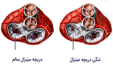 تنگی دریچه میترال